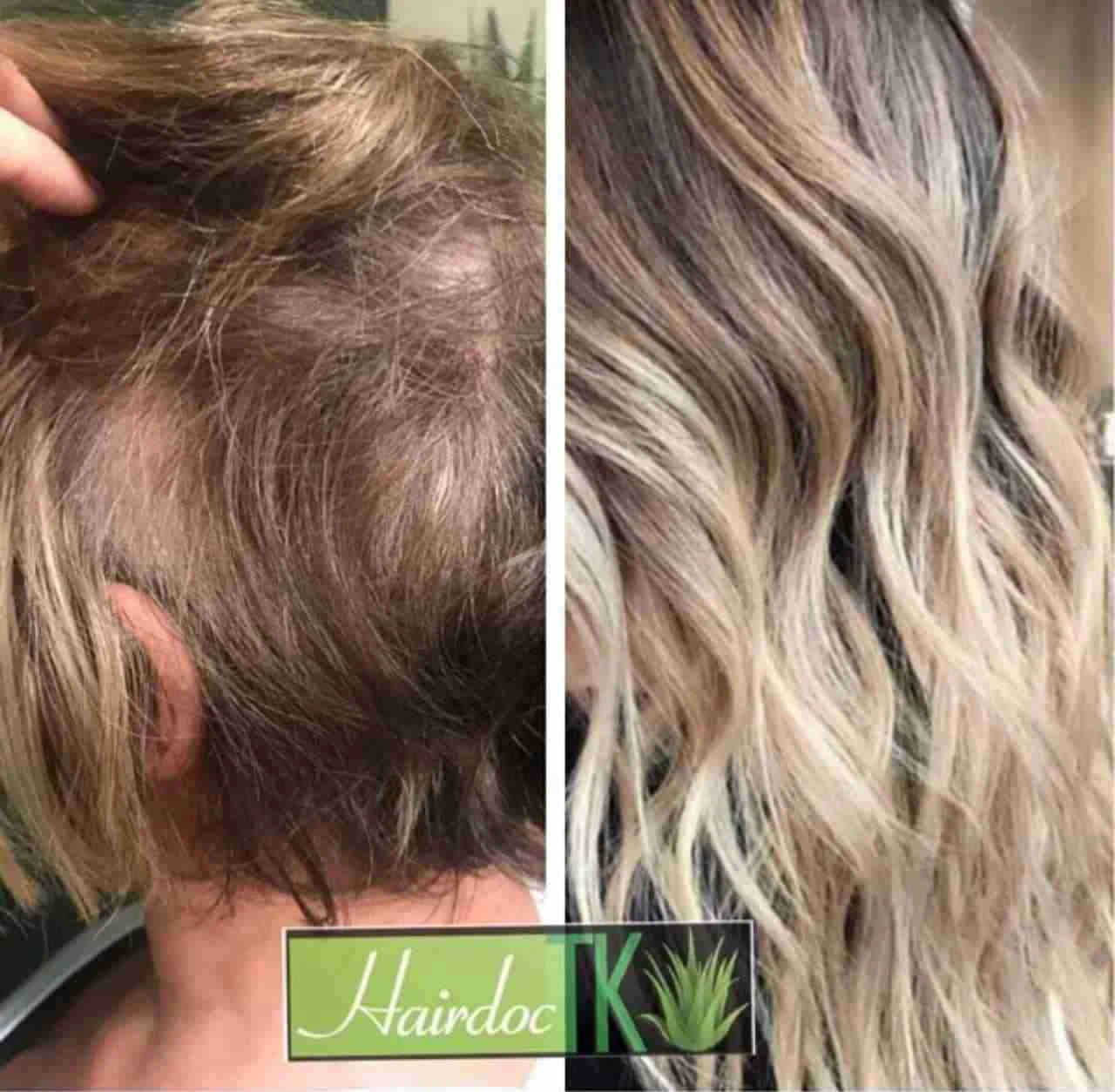trichotillomania-hair-loss-extensions-thinning-hair-scottsdale-salon