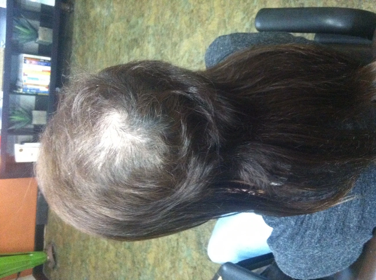 trichotillomania-hair-loss-hair-extensions-scottsdale-hair-expert