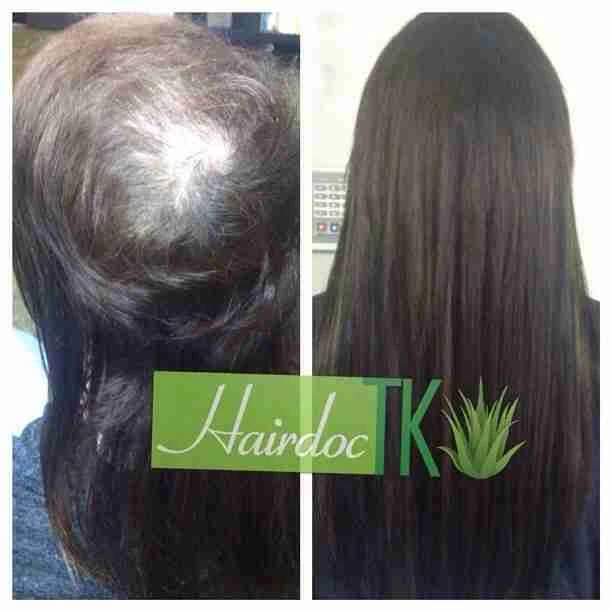 trichotillomania-hair-loss-extensions-hairdoctk-